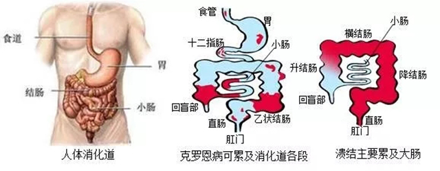 溃疡性结肠炎和克罗恩病的区别(溃疡性结肠炎和克罗恩病的区别方法)  第1张